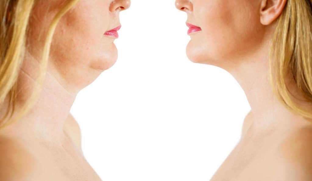 Double Chin treatment Corby before and after results
