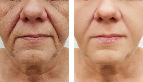 Learn more about Morpheus8 Treatment Corby today!