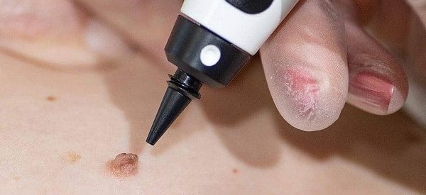 After Skin Tag Removal Corby
