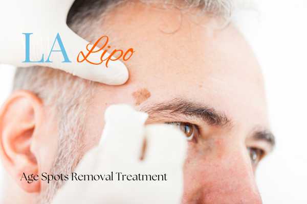 What Are the Most Effective Treatments for Age Spots Corby?