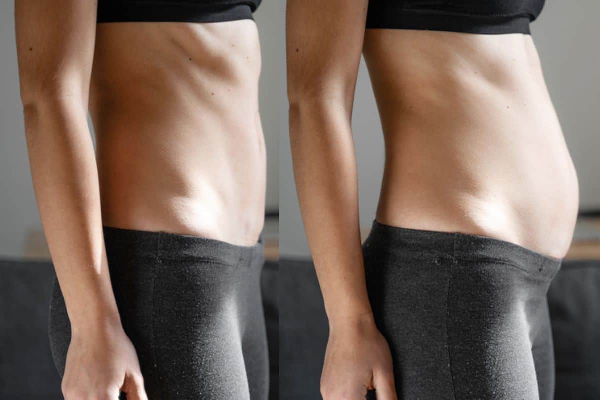 How long does diastasis recti take to improve Corby?