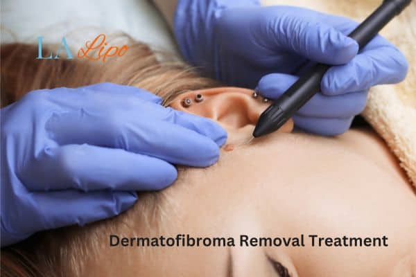 Dermatofibroma Removal Treatment Corby