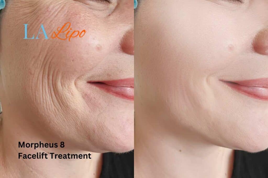 Morpheus8 Treatment Corby for flawless skin! Call us today!