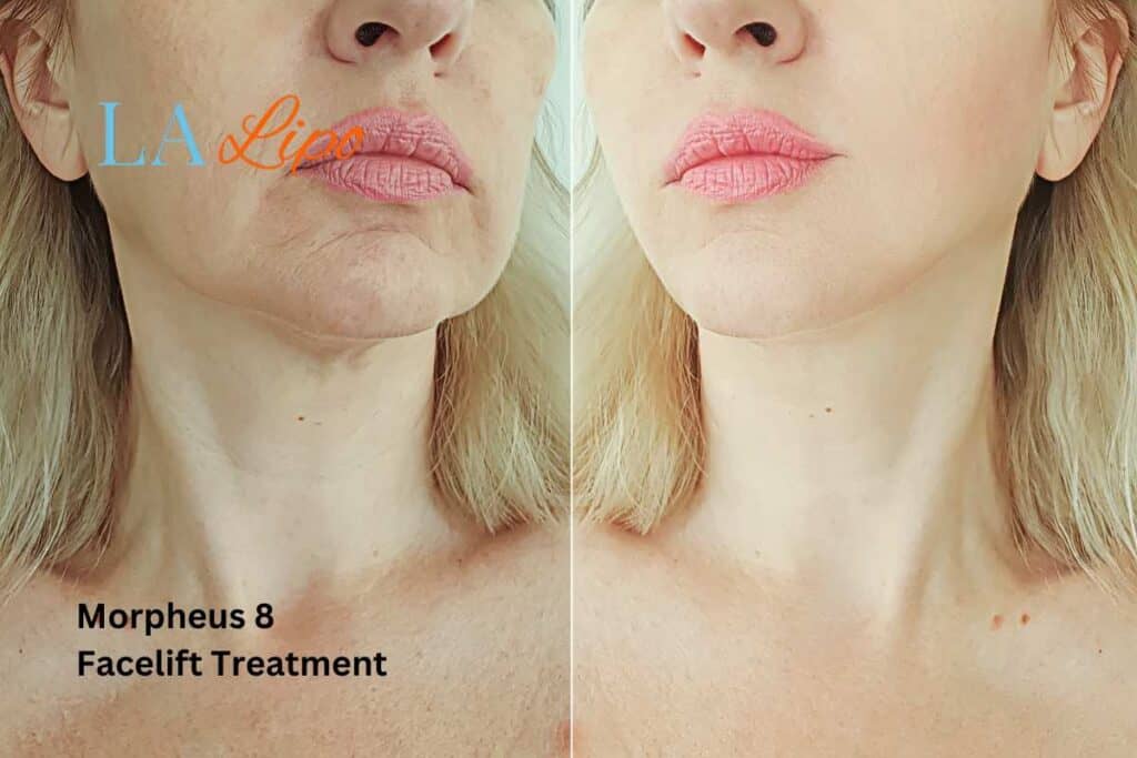 Turn back time with Morpheus8 Treatment Corby