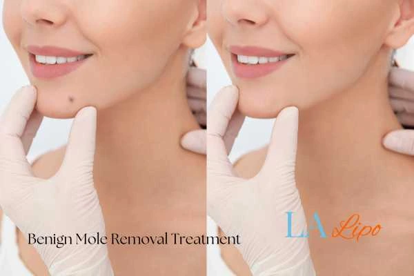 woman's before and after mole removal Corby results
