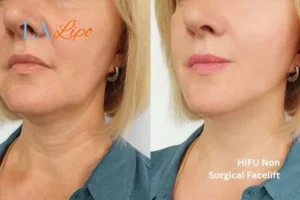 hi-fu for wrinkles Corby before and after results