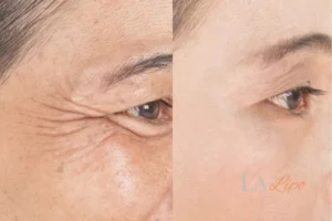 Before and after results of woman - HI-fu wrinkles reduction treatment Corby