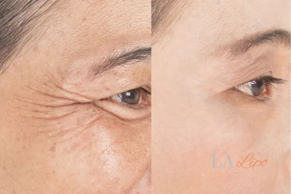 Before and after results of woman - HI-fu wrinkles reduction treatment Corby