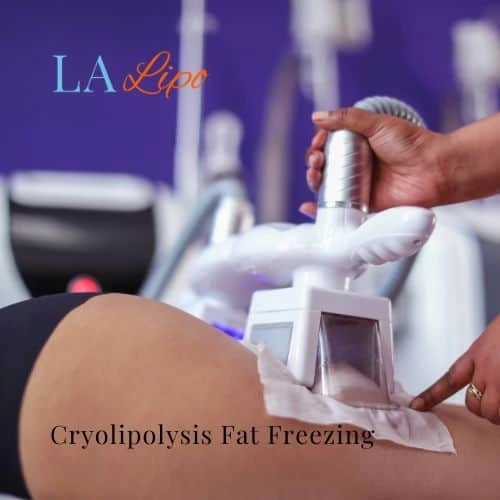 fat freezing - Cryolipolysis Corby