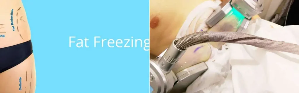 multi areas of a persons body having coolsculpting Corby treatment