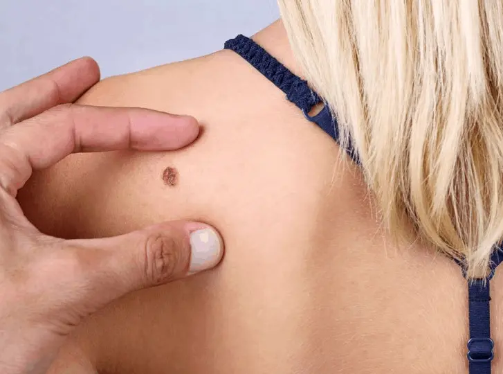 woman having mole removal Corby consultation before treatment.
