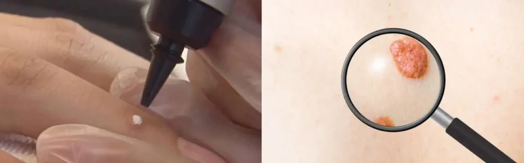 Cryopen for mole removal Corby - speak to our team today!