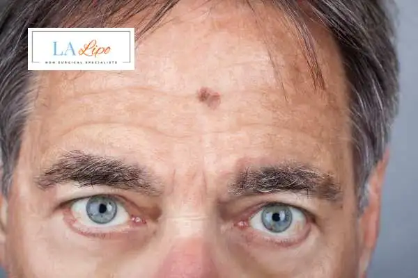 Solar Lentigo Removal Corby image of man with mark on his forehead