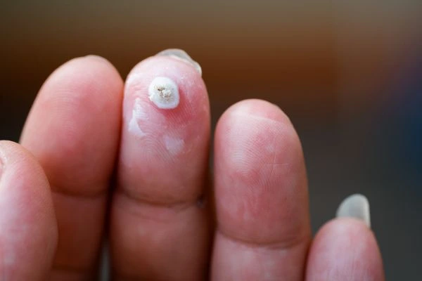 wart on person finger - cryotherapy to treat from LA LIPO Corby