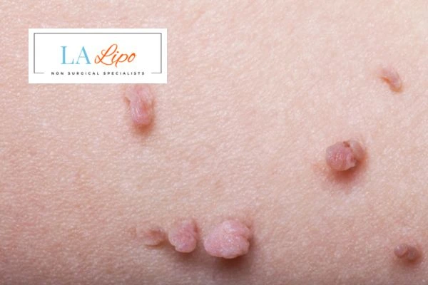 Does cryopen skin tag removal Corby hurt? Find out now call our team today!