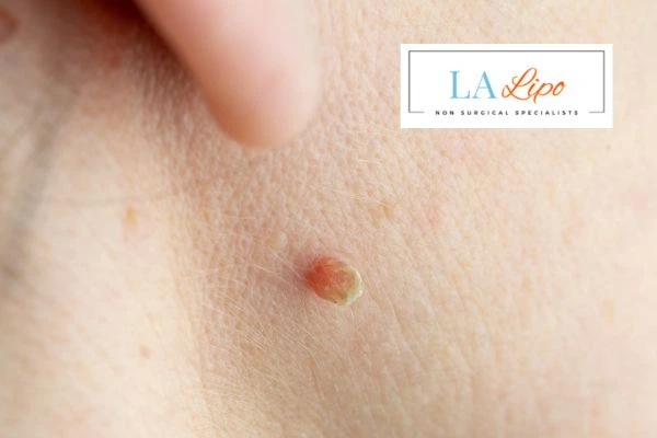 Book skin tag removal Corby today speak to our team now!
