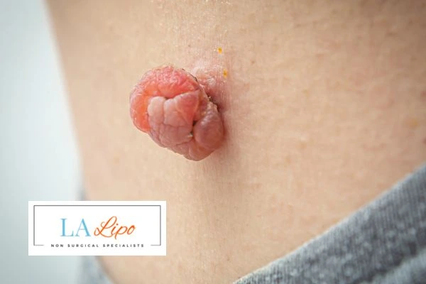 Interested in skin tag removal Corby? Concerned about the pain? Find out more today!