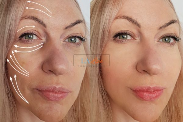 Morpheus 8 results Corby face lift.