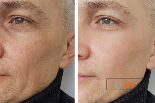 See the amazing results of Morpheus8 Treatment Corby!