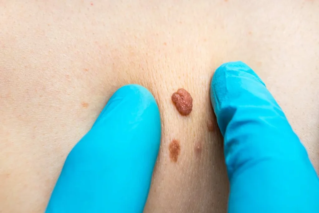 LA LIPO Cryopen Lesion Removal Prices Corby