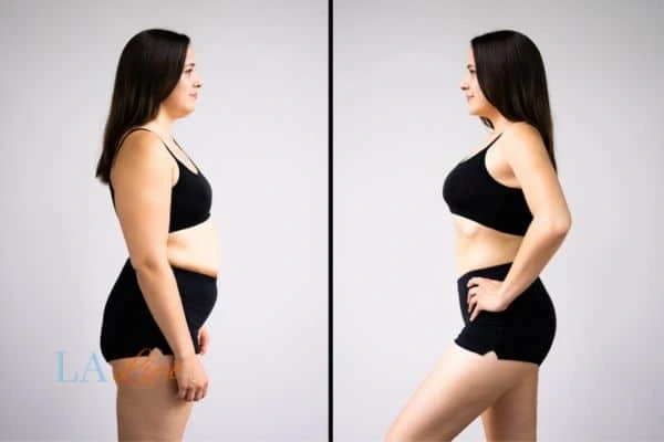 Picture of womans before and after using LA-EMS body sculpting to improve her core strength Corby