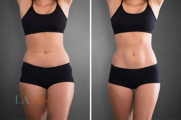 before and after results of non-surgical treatment to help a woman's body image and mental health Corby
