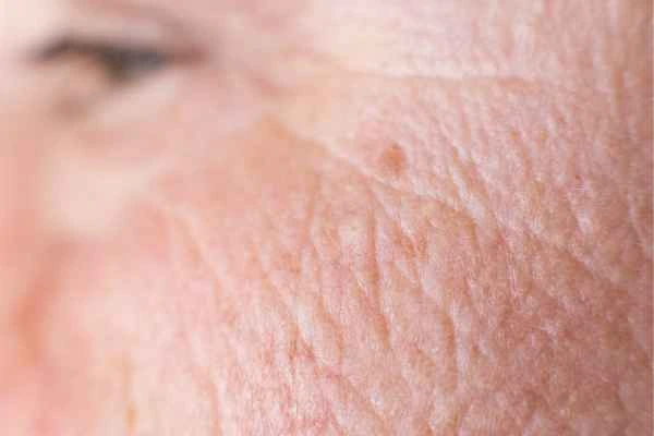 close up picture of a woman's face showing an age spot Corby