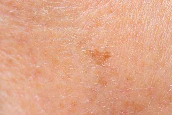 close up picture of age spots Corby