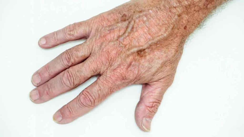 Male hand showing age spot Corby