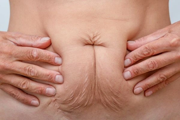 Should I Combine Diastasis Recti Treatment with Body Contouring for Better Results Corby?