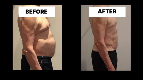 What Symptoms Can Diastasis Recti Cause in Men? Weak Core, Back Pain and Poor Posture Corby